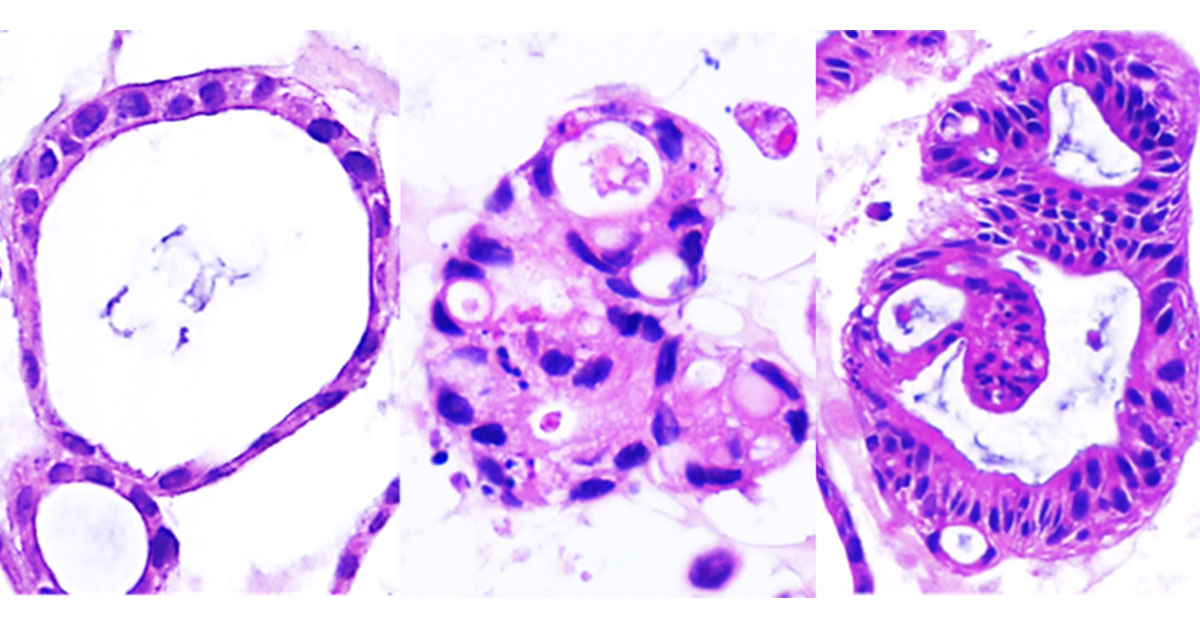 Organoids Derived From Gut Stem Cells Reveal Two Distinct Molecular Subtypes of Crohn’s Disease